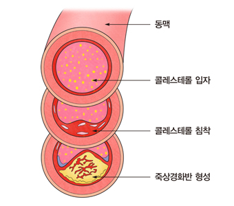 콜레스테롤